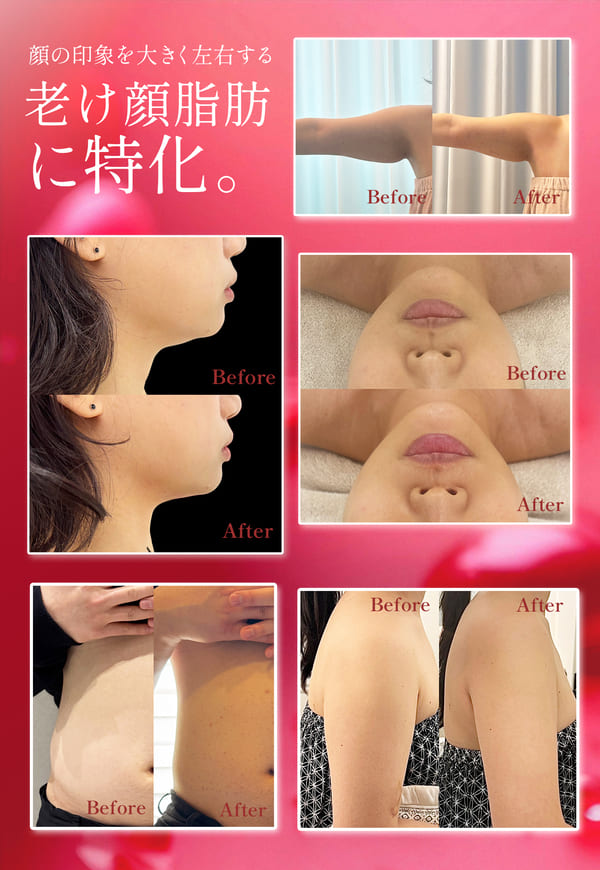 あごした、メーラーファット、バッカルファット、ジョールファット、Lラインファットのビフォーアフター。