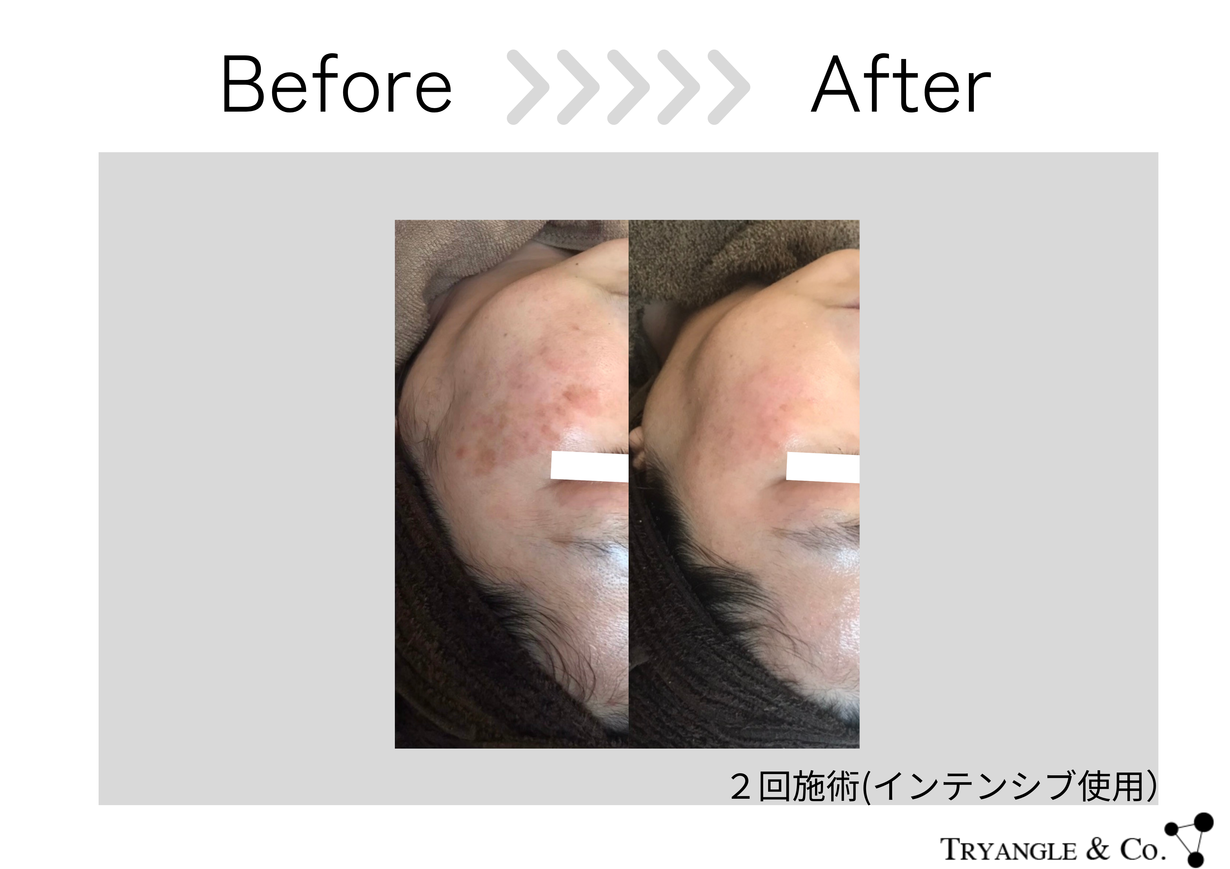 REVIVEナチュラルハーブ シミがたった2回で驚きの結果・・・ - 美容 