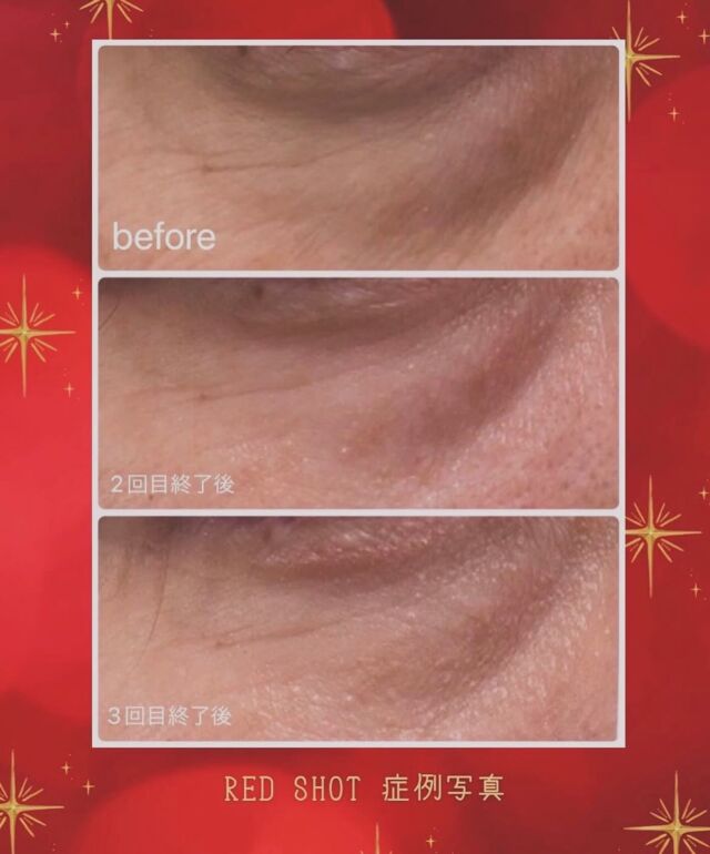 REVIVE インテンシブホワイト 20g シミ全滅への近道？！ REVIVEインテンシブホワイトとは？？ - 美容